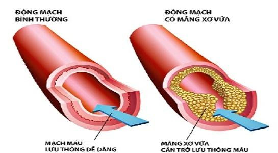 3 bệnh lý tim mạch nguy hiểm do rối loạn mỡ máu 