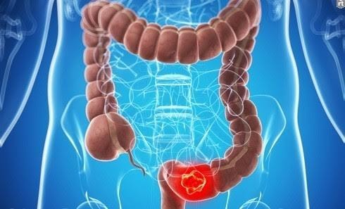 Phải tính đến nồng độ insulin trong máu khi chẩn đoán ung thư trực tràng 