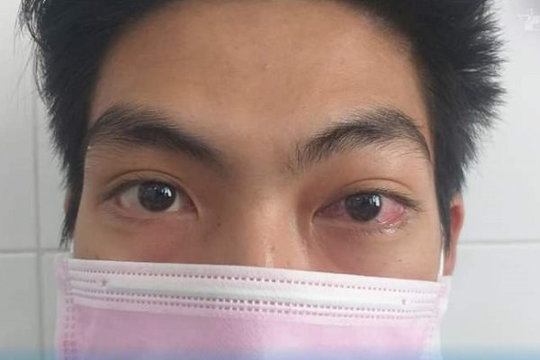 Nam thanh niên suýt mù mắt vì bác sĩ chẩn đoán viêm giác mạc 