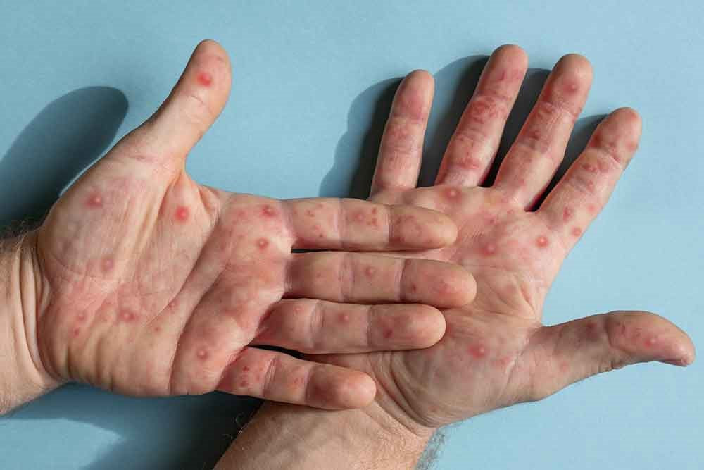 monkeypox-rash.jpeg