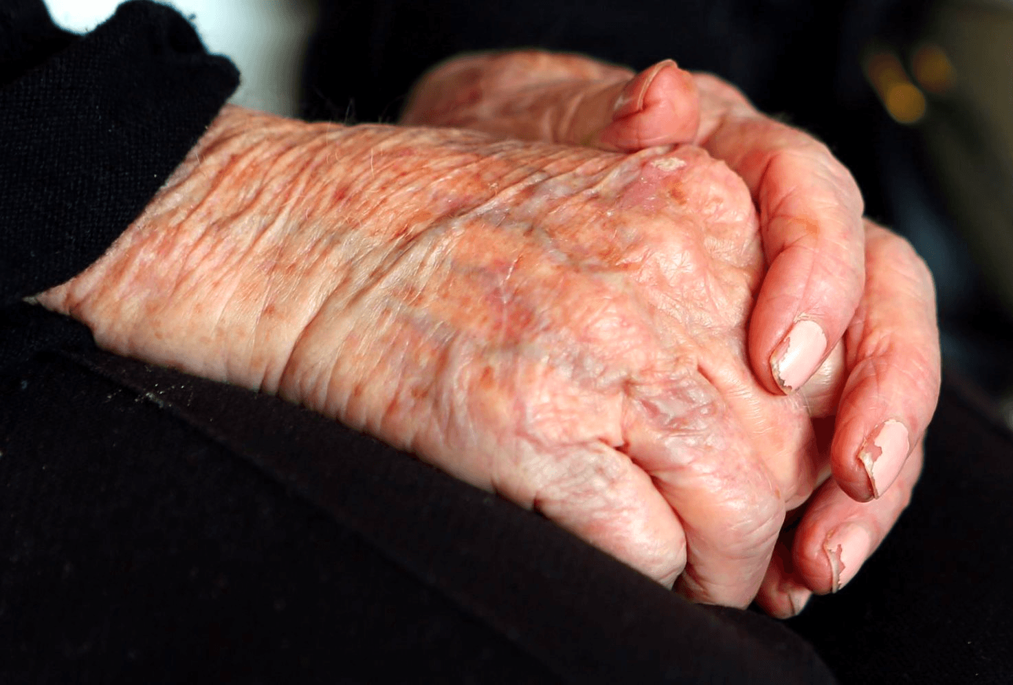 Liệu pháp thay thế hormone có thể ngăn ngừa bệnh Alzheimer ở phụ nữ 