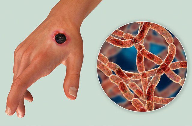 13 người bị mắc bệnh than do ăn thịt trâu, bò: Bộ Y tế chỉ đạo khẩn 