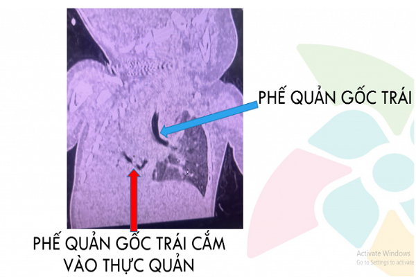 cuu-song-be-gai-3-thang-tuoi-nguy-kich-do-bat-thuong-duong-tho-hiem-gap-hinh-anh.png