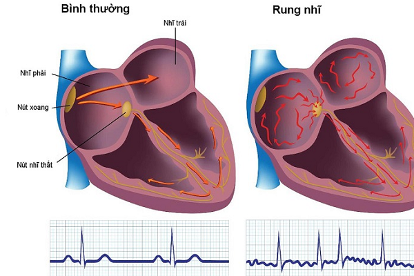 dot-quy-va-dot-tu-noi-am-anmh-cua-benh-nhan-rung-nhi-hinh-anh.png