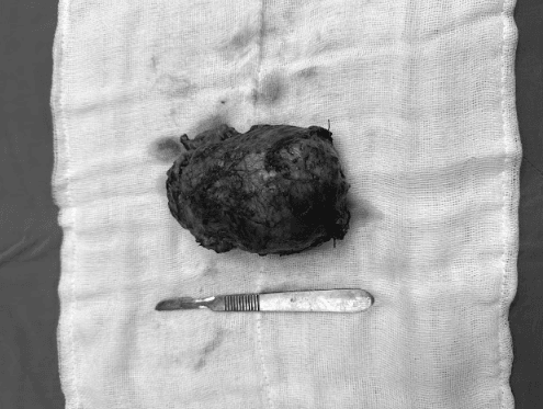 dung-ky-thuat-phuc-tap-bac0si-cuu-nguoi-dan-ong-bi-unghtu-thoat-khoai-an-tu-than-hinh-anh.png