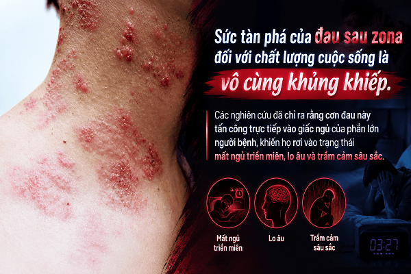 noi-am-anh-sau-zona-than-kinh-da-da-lanh-vi-sao-con-dau-van-gam-nham-nguoi-benh-hinh-anh1.png