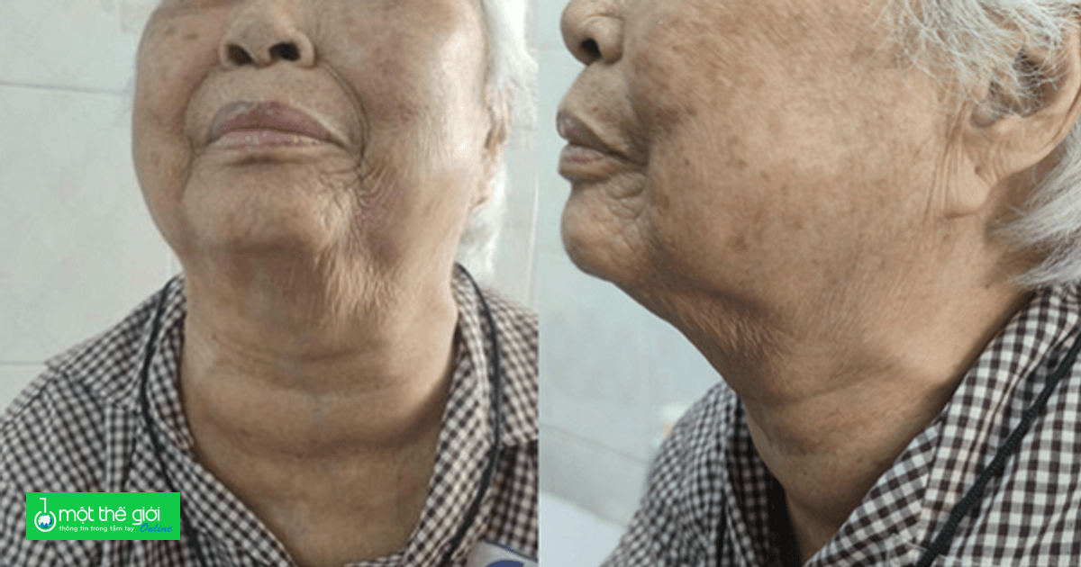 Cụ bà 95 tuổi ở TP.HCM “bỏ quên” khối bướu cổ hơn 40 năm