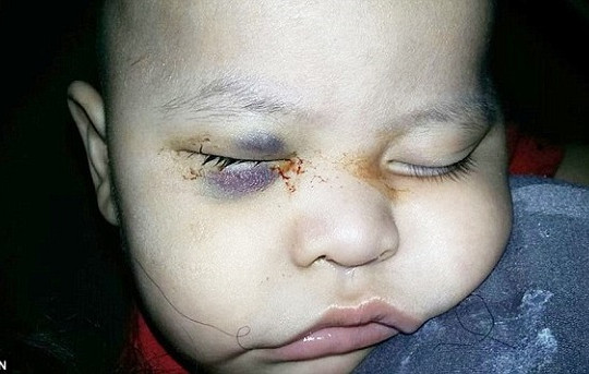 Bác sĩ mổ nhầm mắt làm bé 1 tuổi mù vĩnh viễn