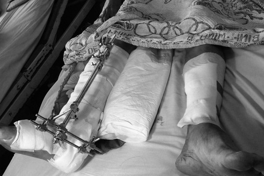 Nhiều người bị máy cắt chém lìa chân phải nhập viện cấp cứu  