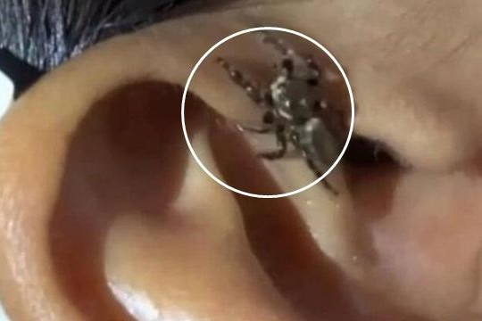 Phát hiện nhện khổng lồ trong lỗ tai người đàn ông 