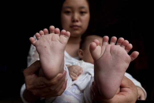 Kỳ lạ đứa bé 4 tháng tuổi có 31 ngón tay chân
