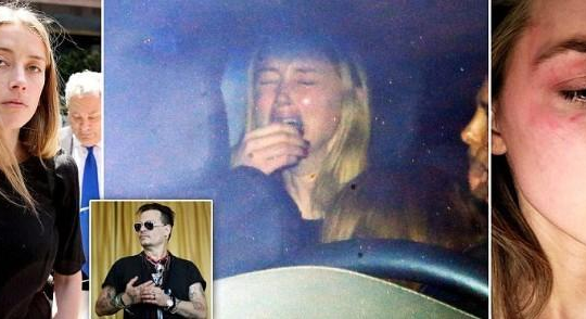 Amber Heard đưa ảnh bầm mắt, tố Johnny Depp bạo hành 