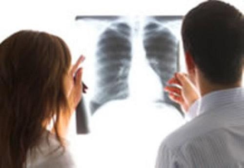  Các chuyên gia hứa hẹn: chữa ung thư phổi sẽ dễ dàng hơn