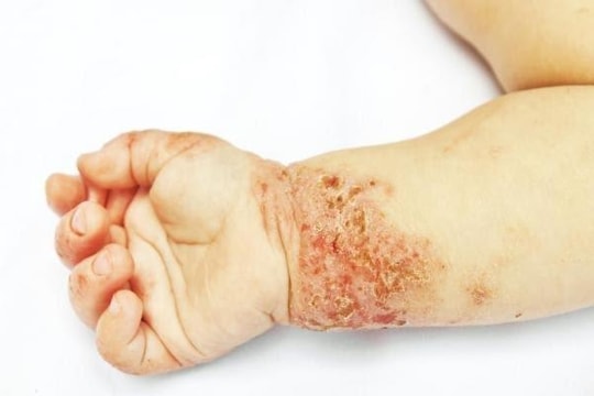  Chẳng bao lâu nữa sẽ có thuốc mới chữa bệnh eczema