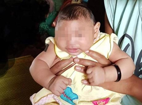 Bé 4 tháng tuổi nghi mắc hội chứng đầu nhỏ do nhiễm Zika đầu tiên tại Việt Nam