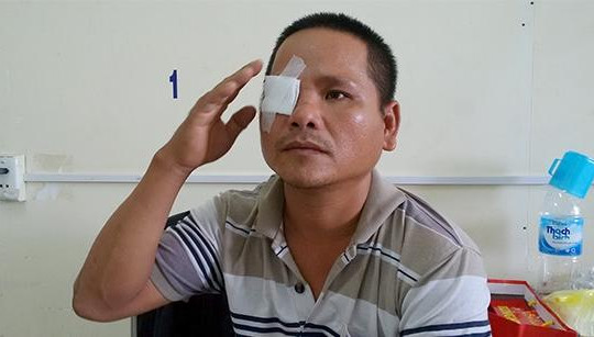 Một người dân tố bị công an bắn đạn cao su bể mắt