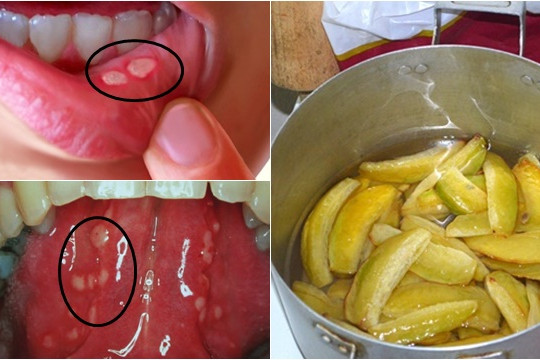 Đun 2-3 quả khế chua lấy nước để ngậm, viêm loét nhiệt miệng khó chịu sẽ biến mất sau 3 hôm