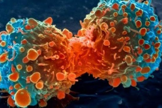 Các tế bào ung thư tạo ra di căn chỉ do trục trặc một gen