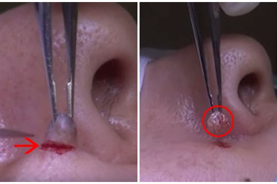 Cận cảnh quá trình cắt bỏ nốt ruồi bên mũi khiến y tá cũng phải khóc thét vì kinh hãi 