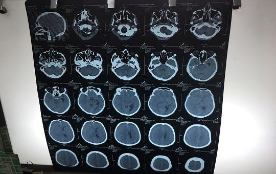  Sau 3 tháng té ngã, người đàn ông mới phát hiện bị chấn thương sọ não 
