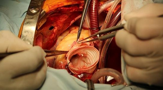 Đà Nẵng: Cứu sống bệnh nhân vỡ phình bóc tách động mạch chủ