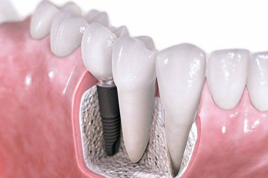 Răng giả kháng khuẩn mọc liền vào xương