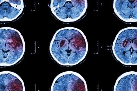 Đã hiểu được cơ chế điều tiết lưu lượng máu trong não