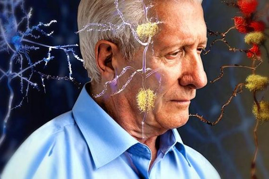 Phát triển được thuốc mới ngừa Alzheimer hiệu quả