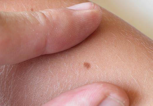 Phát hiện 'tội đồ' khiến các nốt ruồi biến thành ung thư da 