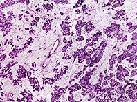 Tìm ra cách phát hiện sớm ung thư di căn từ vú sang phổi