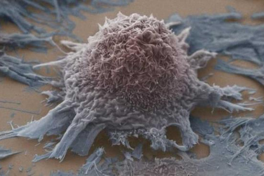 Đã tìm ra cách chặn đường nuôi khối u ung thư