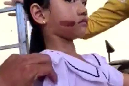Kiên Giang: Khởi tố vụ bé gái nghi bị dí sắt nóng vào mặt