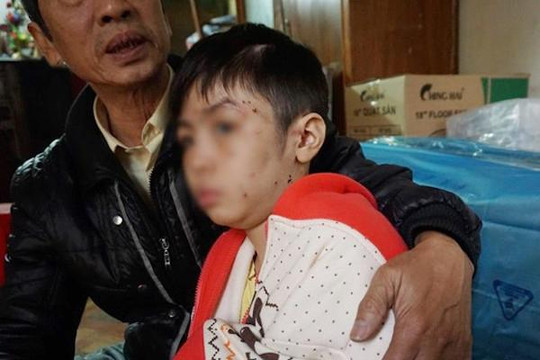 Mẹ kế bé trai 10 tuổi bị bạo hành thừa nhận 'cầm đũa vụt mạnh vào mặt cháu'
