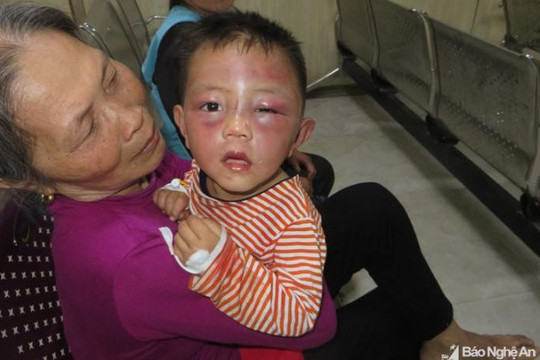 Nghệ An: Điều tra vụ bố dượng bạo hành con riêng 2 tuổi của vợ nhập viện