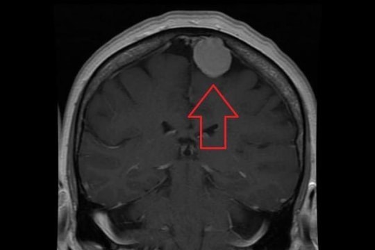 Phát hiện tội đồ khiến u não phát triển