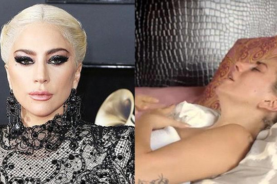 Bệnh tật đau đớn và nỗi ám ảnh bị cưỡng hiếp ở tuổi 72 của Lady Gaga 