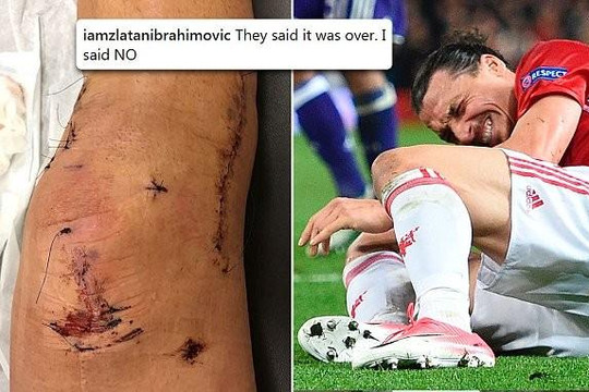 Zlatan Ibrahimovic tiết lộ ảnh khủng khiếp về chấn thương đầu gối ở Man United 