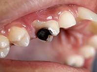 Phát triển phương pháp mới ngừa sâu răng
