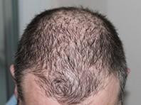 Tổng hợp được hợp chất D-PDMP ngừa rụng tóc và lão hóa da 