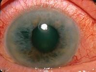 Phát hiện mối liên quan giữa các bệnh về mắt với bệnh mất trí nhớ 