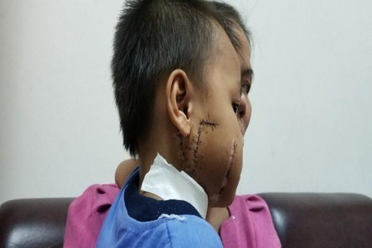 Theo cha mẹ đến chỗ làm, bé trai 6 tuổi bị cánh quạt chém nát mặt
