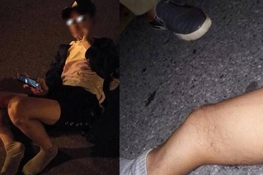 Gãy gập chân vẫn chụp ảnh đăng Facebook, chàng trai Việt nghi bị rối loạn tâm thần 