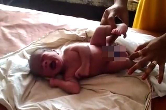Sinh đôi ký sinh: Cậu bé ra đời với 4 chân, 2 bộ sinh dụcNgười dân nhiều nơi đã kéo về TP Gorakhpur, bang Uttar Pradesh, Ấn Độ, để chứng kiến một cậu bé chào đời với 4 chân và 2 bộ sinh dục.
