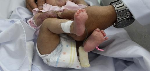 Lần đầu tiên dùng máy lực âm cứu sống bé sơ sinh bị nhiễm trùng