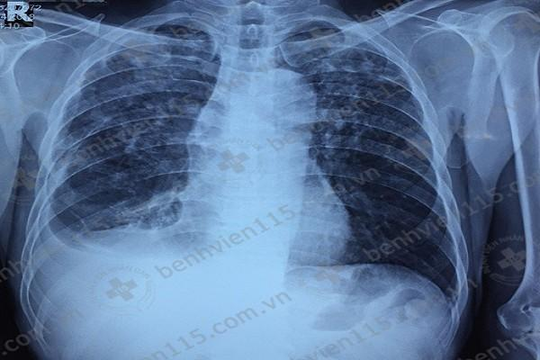 Bùng phát bệnh lao phổi ở bệnh nhân suy nhược cơ thể