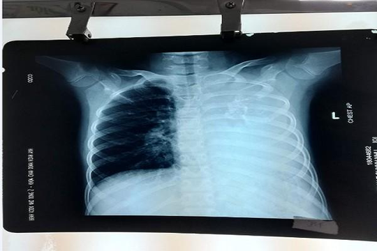 Lần đầu tiên phát hiện bé gái 10 tuổi có khối u phổi bẩm sinh 