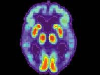 Mỹ phát triển thuật toán chẩn đoán chính xác bệnh Alzheimer