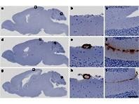 Cảnh báo nguy cơ lây nhiễm bệnh Alzheimer