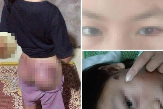 Hà Tĩnh: Công an viên đánh bé gái bầm tím mông vì nghi trộm tiền