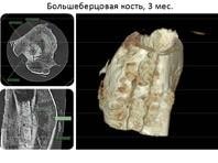 Nga phát triển vật liệu ghép xương độc đáo
